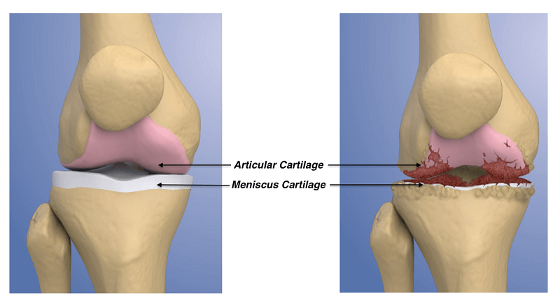 Cartilage damage