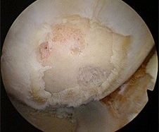 Damaged articular cartilage