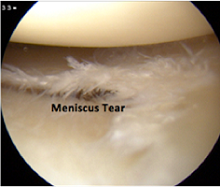Meniscus cartilage tears