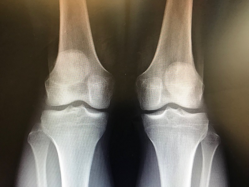 Frontal View X-Ray