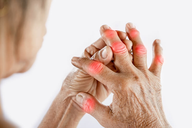 JOINT DEFORMITIES IN RHEUMATOID ARTHRITIS