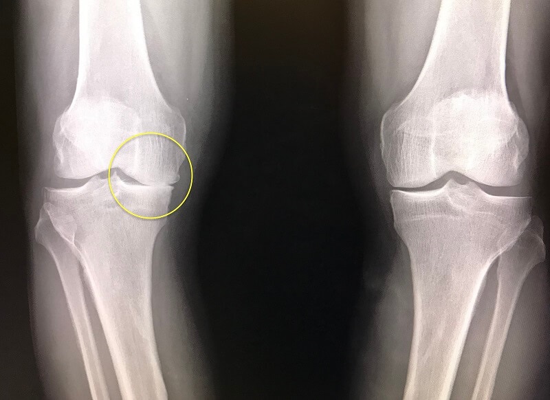 WHAT DOES KNEE OSTEOARTHRITIS LOOK LIKE ON X-RAY
